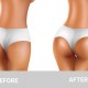 Options and Preparation for Butt Augmentation