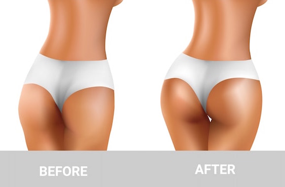Options and Preparation for Butt Augmentation