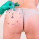 Time needed to recover from buttock augmentation