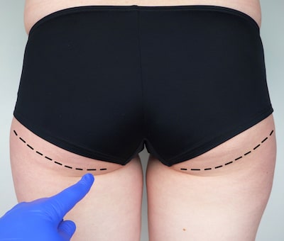 Recovering after a buttock augmentation